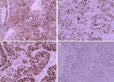 Figure 1 From Gastric Metastasis Of Ovarian Serous Cystadenocarcinoma Semantic Scholar