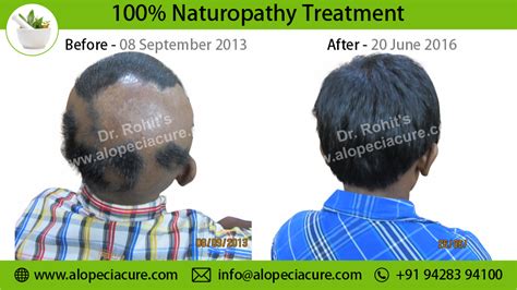 Alopecia Areata Treatment Types Causes