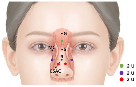 Novel Anatomical Guidelines On Botulinum Neurotoxin Injection For