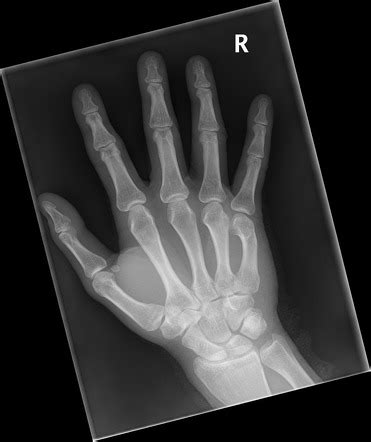 Fifth metacarpal fracture malunion | Radiology Case | Radiopaedia.org