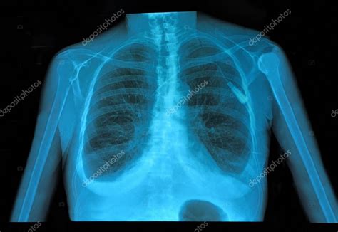 Xray lung Stock Photo by ©kravka 25498261