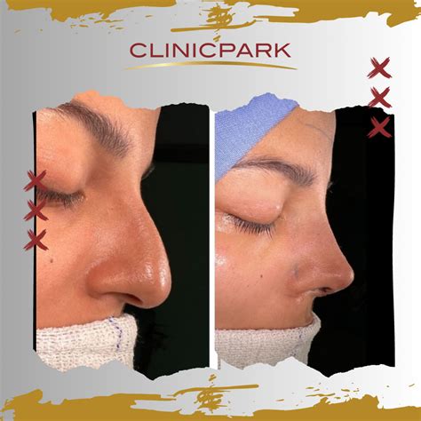 Nose Job Turkey Clinicpark