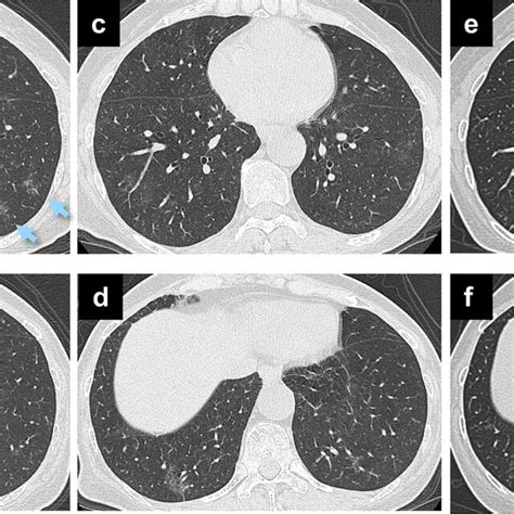 Positron emission tomography integrated with computed tomography scans ... 