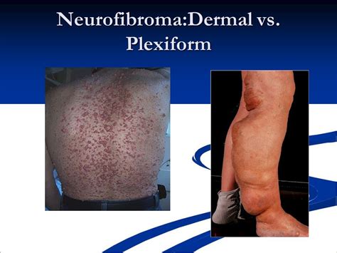 Plexiform Neurofibromas