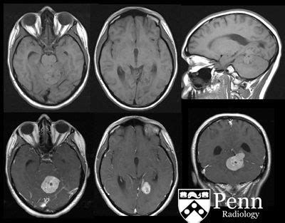 A 27-year-old woman with vertigo, ataxia, and headaches. | Vertigo ...