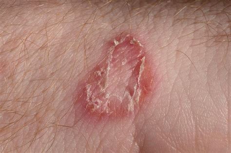 Tinea Corporis Tigna Della Pelle Cause Sintomi E Cura