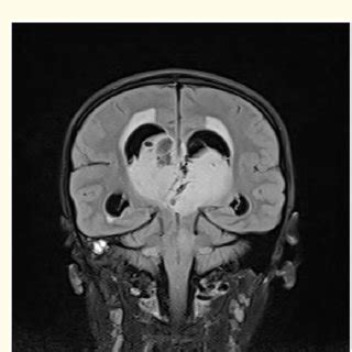 MR Scan Of Head Axial T2W1 Image Showing Bilateral Thalamic Glioma With