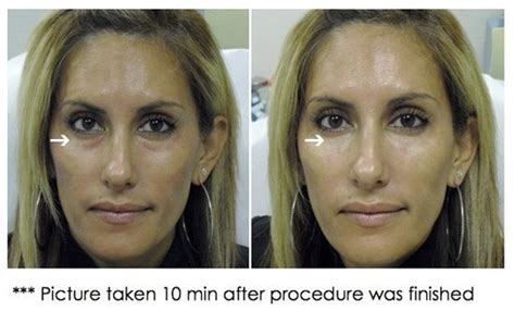 Juvederm For Under Eye Bags Before And After Omg Juvederm Under Eyes Juvederm Restylane