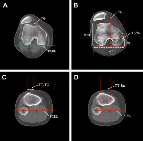 Method Of Measuring The Tibial Tubercle Roman Arch Tt Ra Distance And