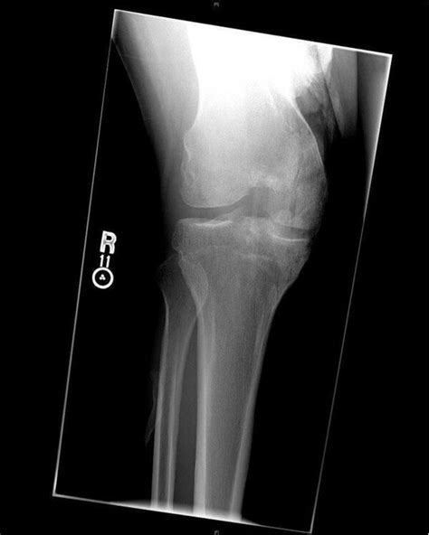 Anteroposterior X Ray Of The Patients Right Knee At The Time Of Download Scientific Diagram