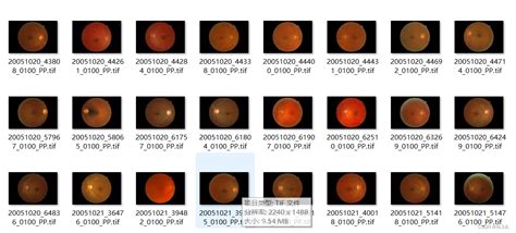 常用眼底图像数据集简介及下载 糖尿病视网膜病变 EyePacs APTOS2019 STARE数据集 CSDN博客
