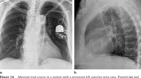 Figure 5 From Radiography Of Cardiac Conduction Devices A