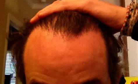 How to Fix My Uneven Hairline? And Estimated Cost? | Dr. Rahal