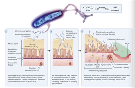 Helicobacter Pylori Gastritis Flashcards Quizlet