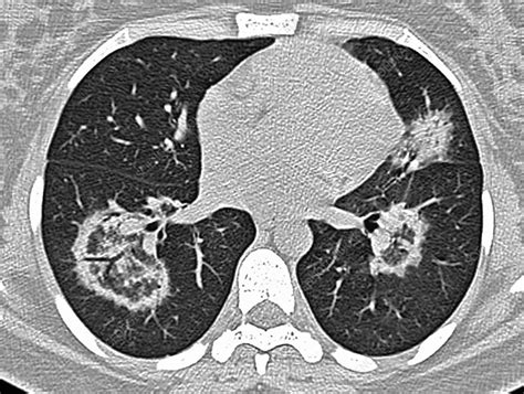 Pneumonia Lung Ct Scan