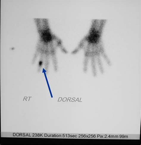 Enchondroma Benign Bone Tumor Tumors Of Bone