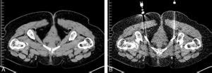 Les Fondamentaux Chapitre Radiologie Interventionnelle Cnp Mn