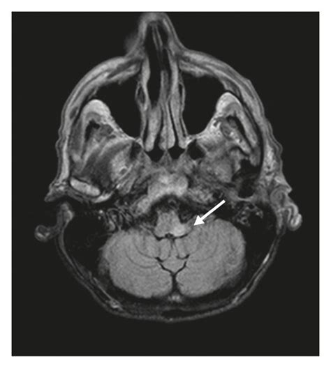 Flair Fluid Attenuated Inversion Recovery Images A Focus Of Download Scientific Diagram