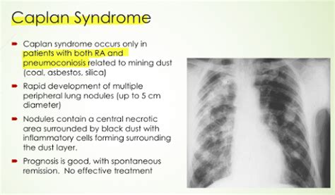 Caplan Syndromewhat To Know