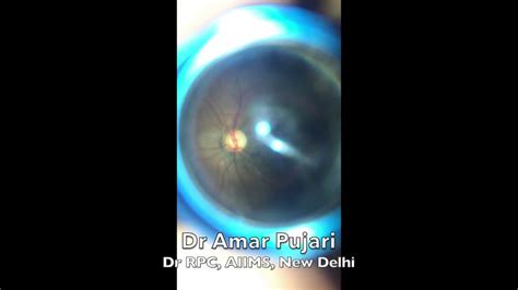 High Definition Optic Disc And Posterior Pole Retinal Imaging Using