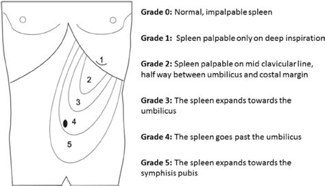 Hackett S Grading System For Palpable Splenomegaly Download