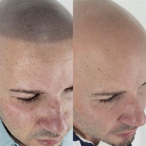 Micropigmentaci N Capilar Antes Y Despu S Del Tratamiento Scalp Clinic Pr