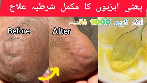 Crack Heel Remedy Phati Ariyan Ka Ilaj World S Best Home Remedy To