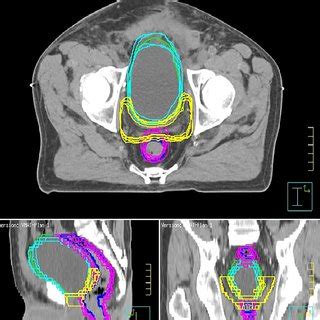 A Rectum Volume In CTs Rectum Volume Variations The Mean Volume And