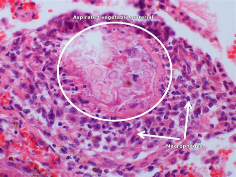 Aspiration Pneumonia Pathophysiology Wikidoc