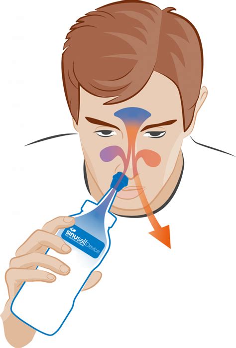 Nasal Irrigation Sinusalt Device