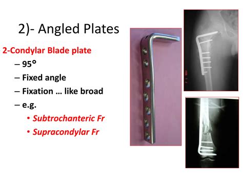 Orthopedic surgery INSTRUMENTS (short overview).pptx