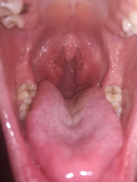 Do My Tonsils Look Normal R Tonsilstones