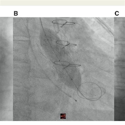 A Intraventricular Digital Subtraction Angiogram Demonstrating