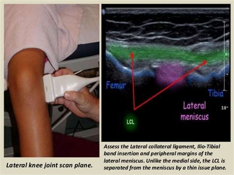 Presentation1 Pptx Ultrasound Examination Of The Knee Joint