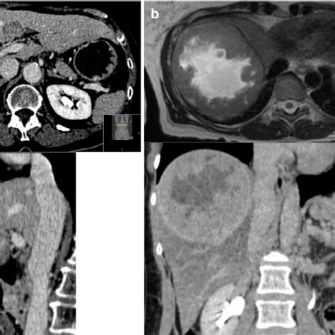 CT Scans A Axial And Sagittal Preoperative CT Images Of CRLM At 6 Mm