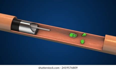 128 Laser Lithotripsy Images, Stock Photos, and Vectors | Shutterstock