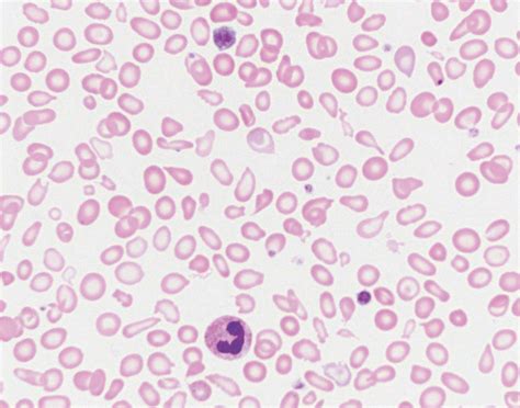 Peripheral smear. The red blood cells are hypochromic and microcytic ...