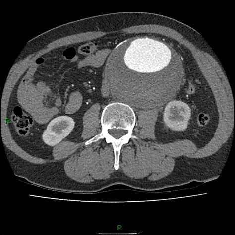 Abdominal Aortic Aneurysm – Core EM