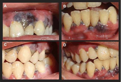 Necrotizing Ulcerative Gingivitis Before And After