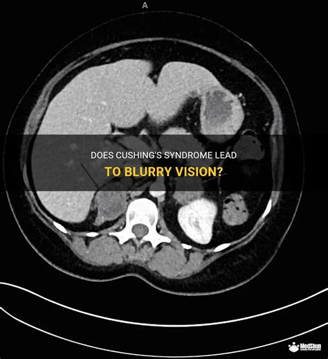 Does Cushings Syndrome Lead To Blurry Vision Medshun