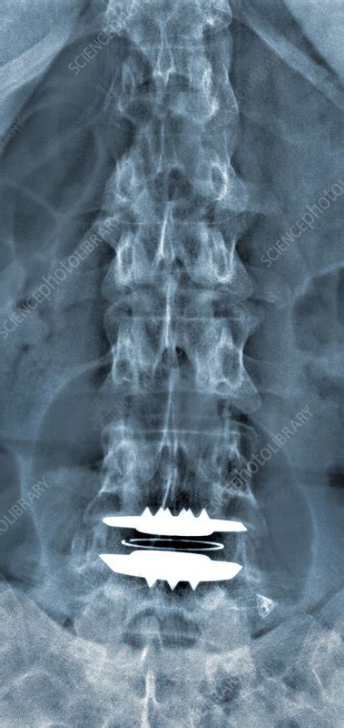 Lumbar Vertebrae Arthroplasty X Ray Stock Image C003 4802