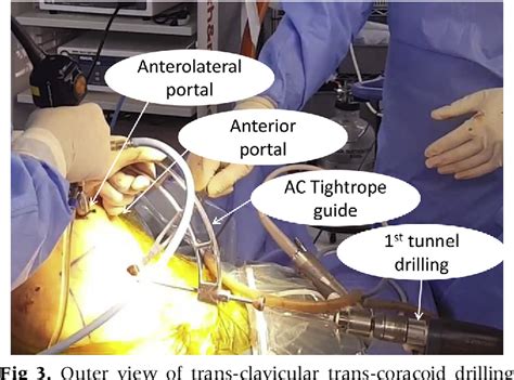 Figure 1 From Arthroscopic Coracoclavicular Fixation Technique Using