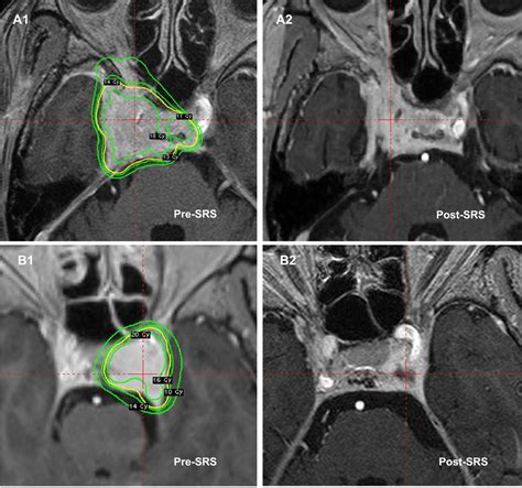 Diagnostic Radiological Imaging Using Post Contrast T1 Weighted