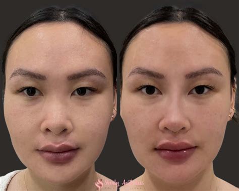 Non Surgical Rhinoplasty Before And After Results Off