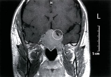 Craniopharyngioma And Pituitary Adenoma