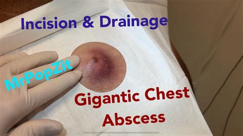 Giant Inflamed Abscess On Chest Incision Drainage So Much Inside