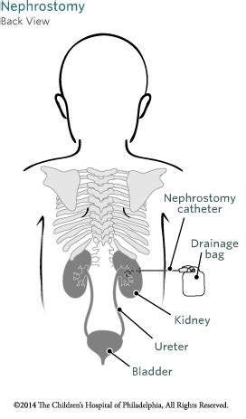 Nephrostomy Tube | Children's Hospital of Philadelphia