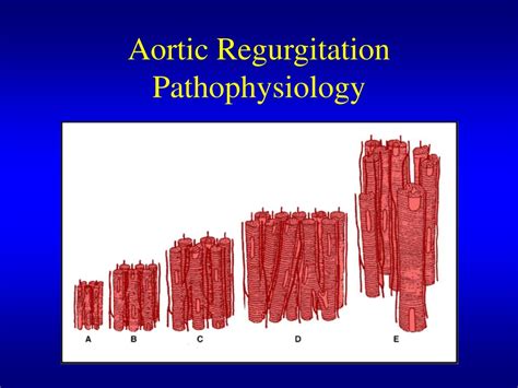 Ppt Aortic Insufficiency Acute And Chronic Powerpoint Presentation Free Download Id 4230992