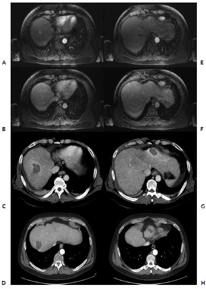 5 Liver Ablation | Radiology Key