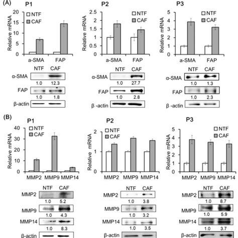 CAF Marker And Matrix Metalloproteinase MMP Expression In Primary